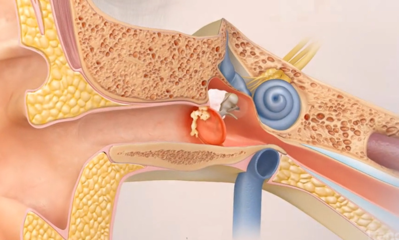 What is cholesteatoma? - Knox Audiology - Knox Hearing Clinics